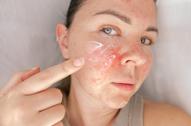 Understanding Tacrolimus Cream: A Modern Approach to Managing Eczema and Sensitive Skin Conditions